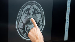 Tirzepatide may only temporarily suppress ‘food noise’