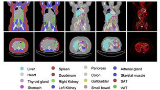 PET imaging tracks whole-body metabolic changes after surgery