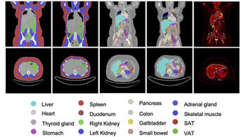 PET imaging tracks whole-body metabolic changes after surgery