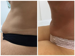 Protocolo Combinado para Gordura Localizada 17.JPG