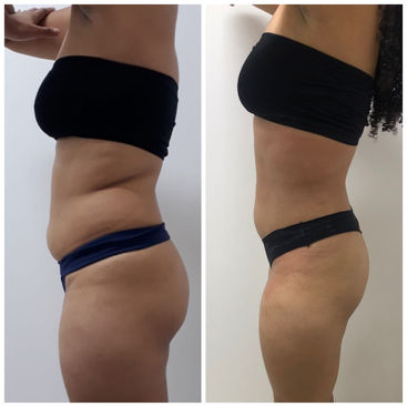 Protocolo Combinado para Gordura Localizada 14.JPG