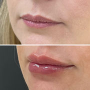 Preenchimento Labial (2).JPG