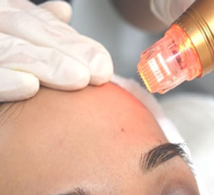 RF-Microneedling-3.jpg