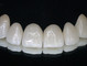 4.FACETAS-DE-PORCELANA-SISTEMA-E.MAX