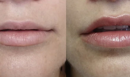 Lip-Lift.jpg