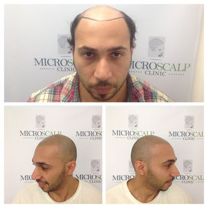 Blog Micro Scalp Clinic Boston Micro Scalp Clinic