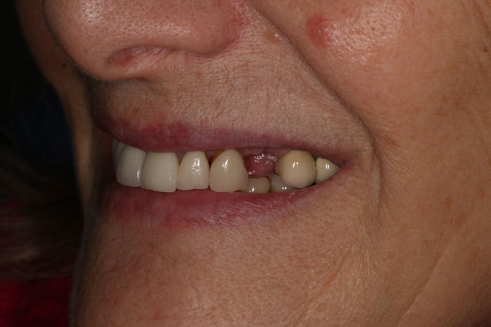 Extracted premolar