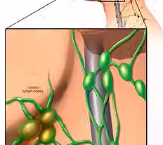 swollen-lymph-nodes (1).avif