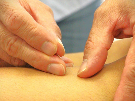 Acupuncture in Perth for Recurring Neck Pain