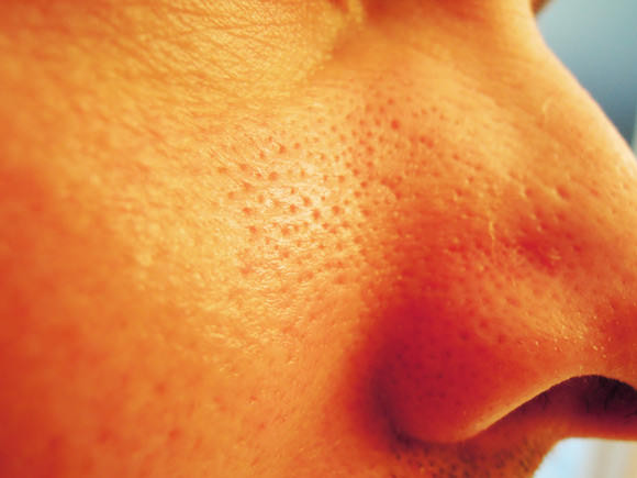 Closeup of clogged pores on a woman's cheek