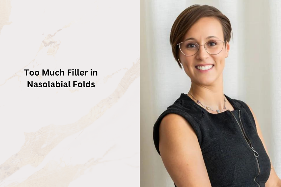 Too Much Filler in Nasolabial Folds