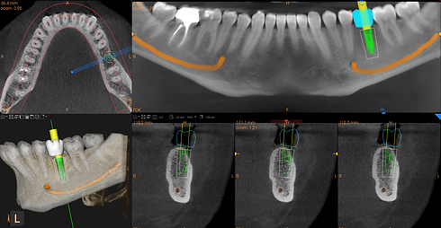 3_cs-8200-3d-access_10x5_implant-planning.png