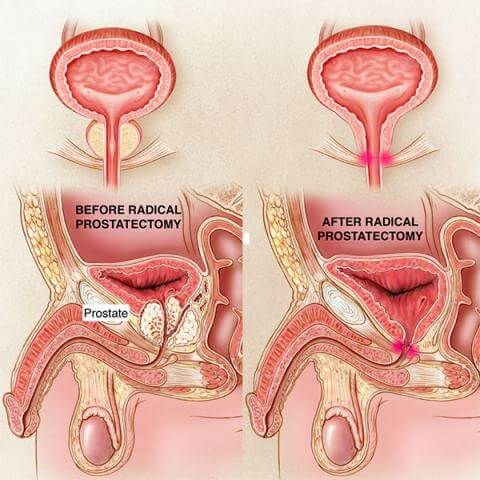 Anatomia antes e depois da cirurgia de retirada da próstata.