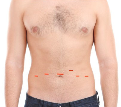 Abdome com desenho de incisões e cicatriz após cirurgia robótica para a próstata