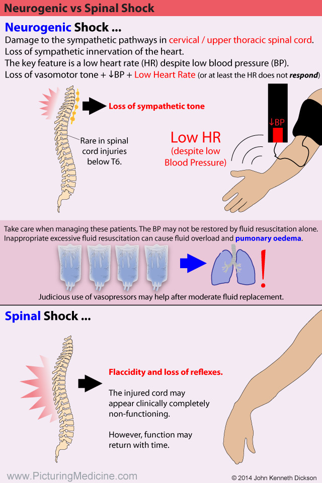 Spinal Shock vs Neurogenic Shock Spinal Shock vs Neurogenic Shock