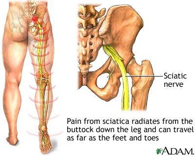SCIATIC