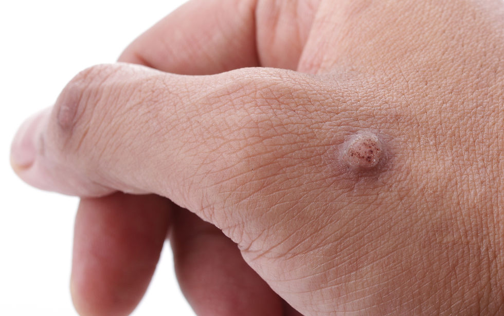 wart treatment, cryotherapy