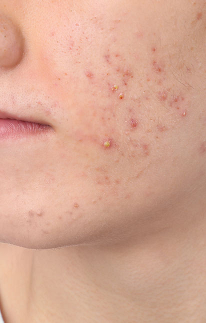 Effective Acne Treatment | Aislyn Dermatology
