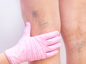 When Should You Worry About Varicose Veins?