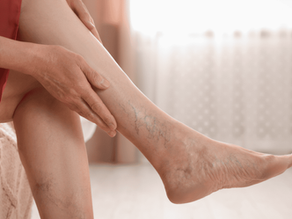 How To Remove Varicose Veins In Legs Naturally