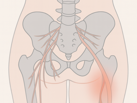 Compromiso de los nervios pélvicos por endometriosis: una forma poco reconocida pero potencialmente discapacitante