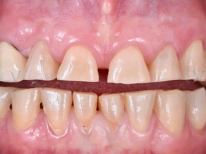 Diferenciando Tipos de Desgaste Dental: Entendiendo Causas y Prevención