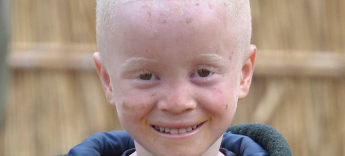 ALBINISM AWARENESS DAY 13ab.jpg