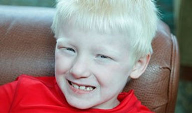 ALBINISM AWARENESS DAY 5ab.jpg