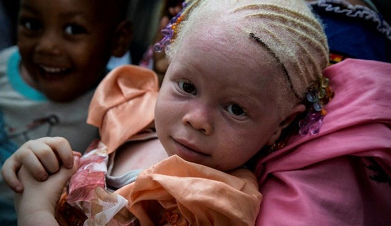 ALBINISM AWARENESS DAY 4ab.jpg