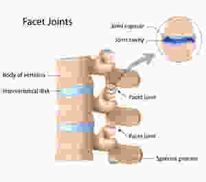 Wry neck pain, facet joint pain