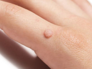 Warts!