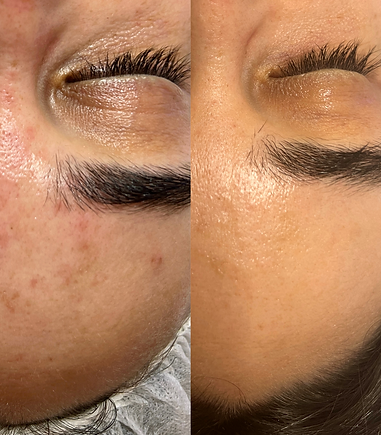 Vorher Nachher Fotos von links gesicht mit gigmentfleckenStirn, rechts ist die Haut fast ebenmäßig nach Behandlung bei Ewa Jacob in München und Menden Sauerland.