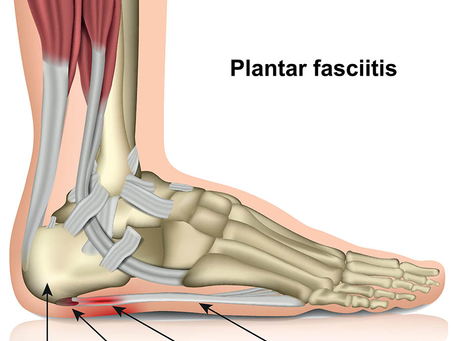 Plantar Fasciities
