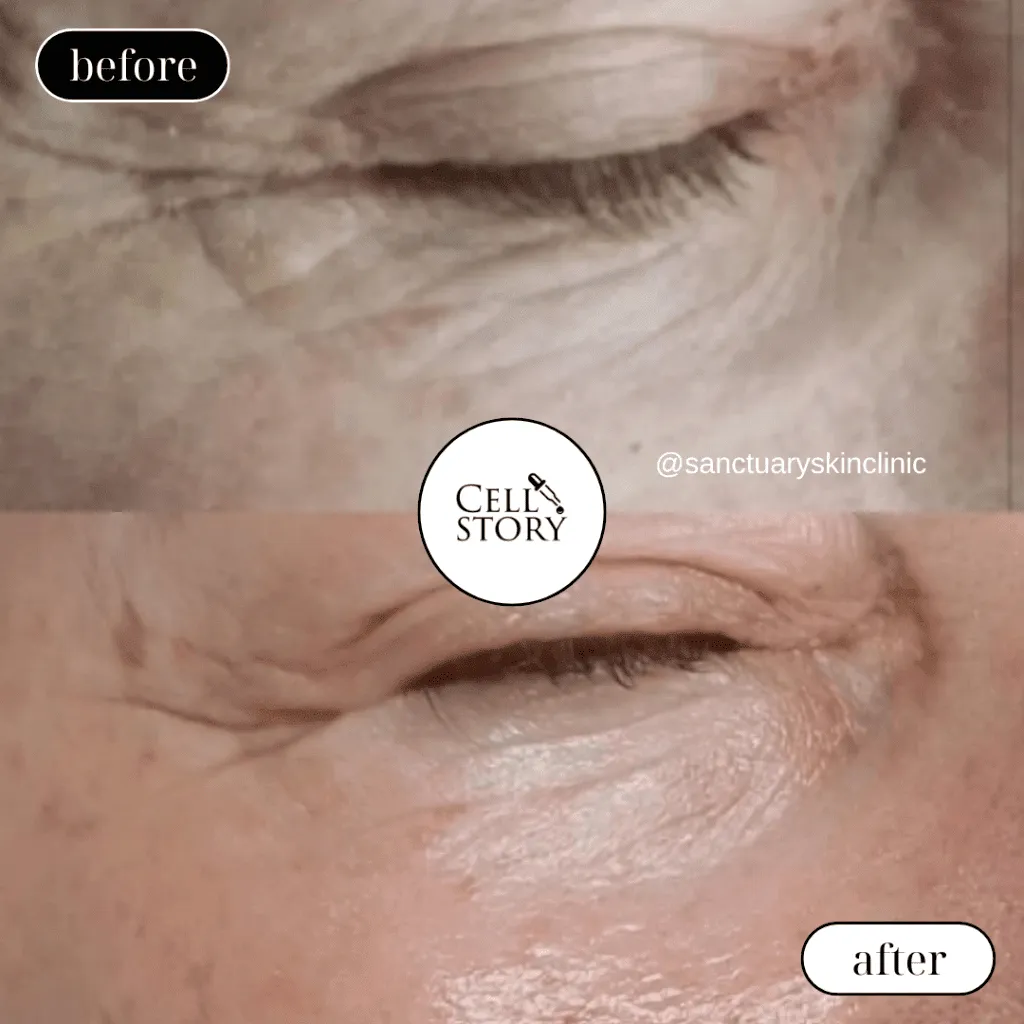 Before and after Cellstory treatment Skin Revival Specialist Marlow Bucks
