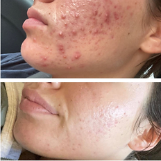 Acne client who did not want to go on roaccutane. They had a corse of cold plasma treatments with us and these are the amazing results.