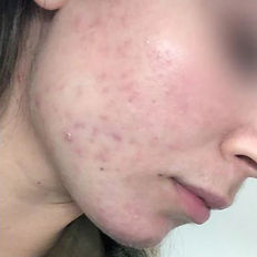 Acne client after course of treatments