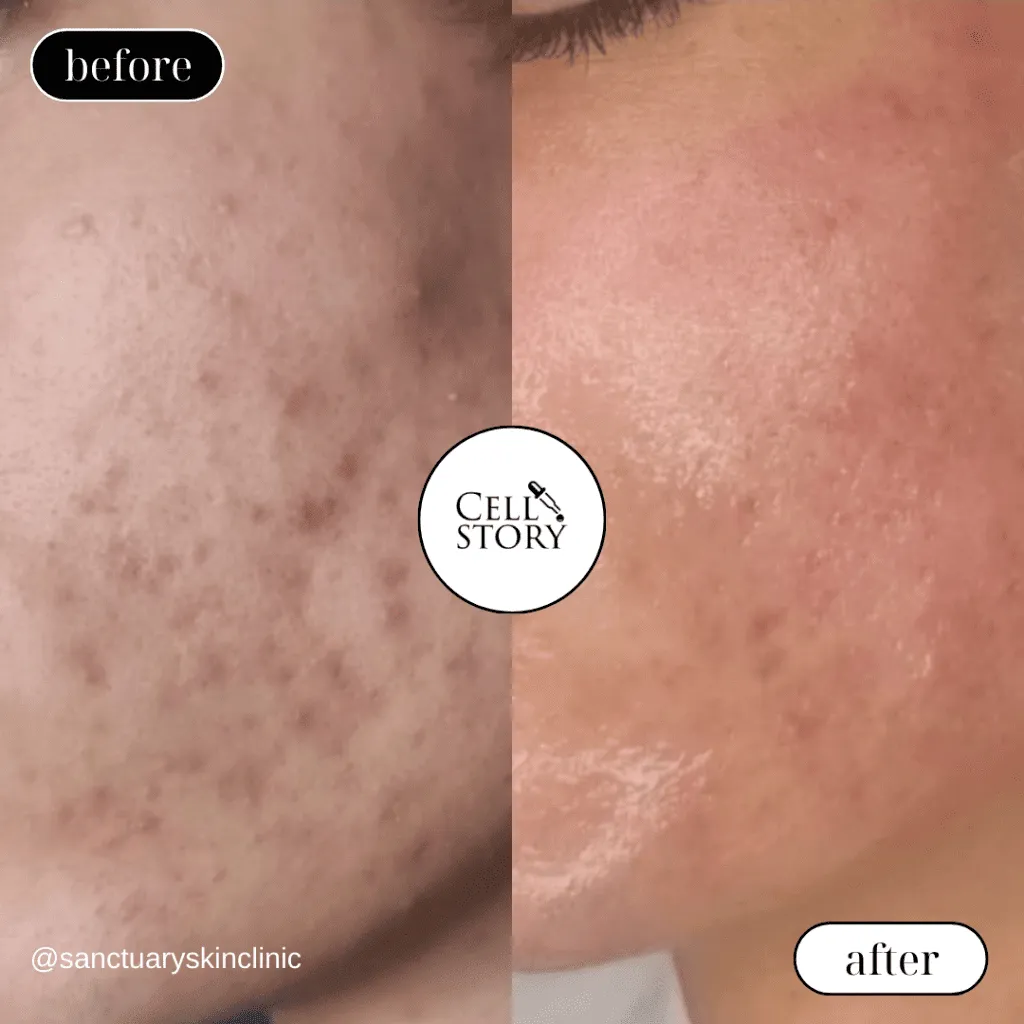 Before and after Cellstory treatment Skin Revival Specialist Marlow Bucks