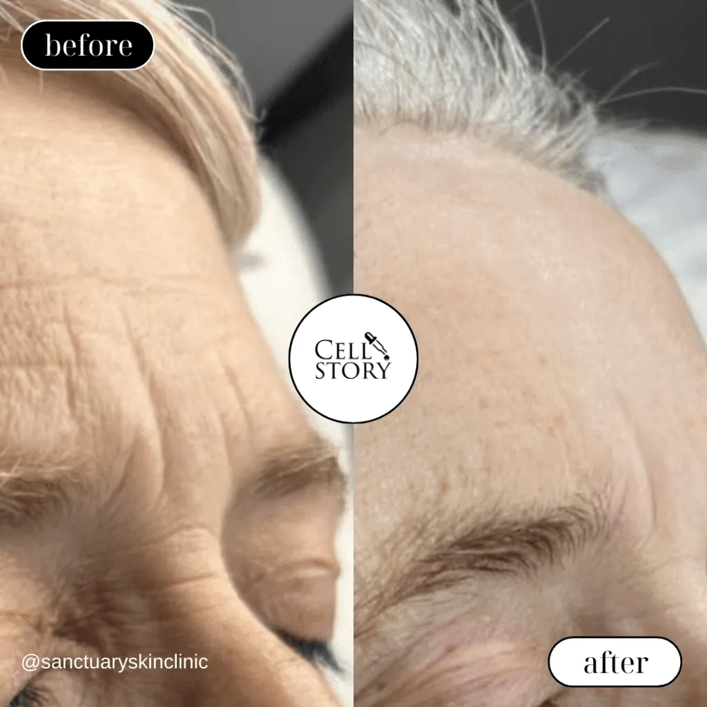 Before and after Cellstory treatment Skin Revival Specialist Marlow Bucks