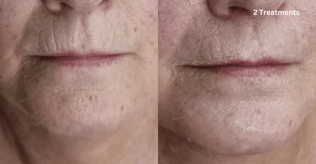 Before and after Cellstory treatment Skin Revival Specialist Marlow Bucks
