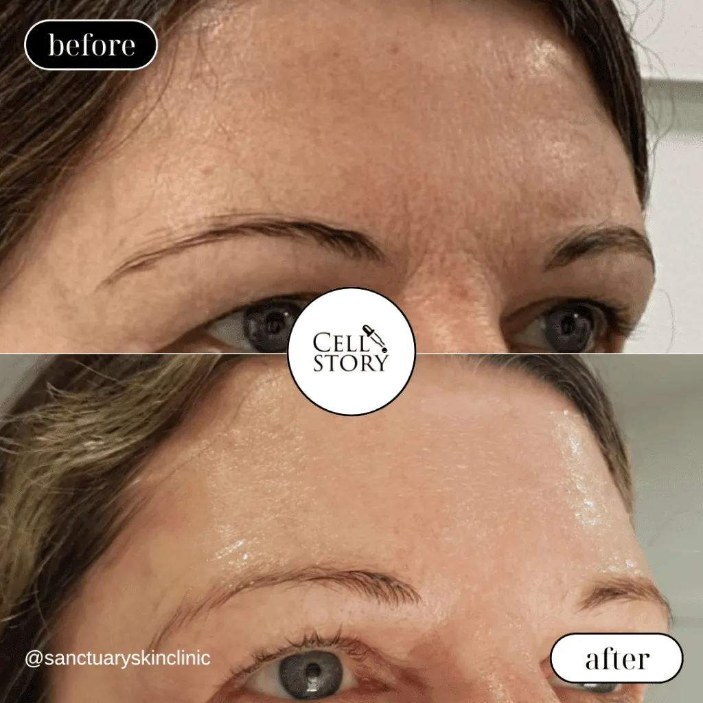 Before and after Cellstory treatment Skin Revival Specialist Marlow Bucks