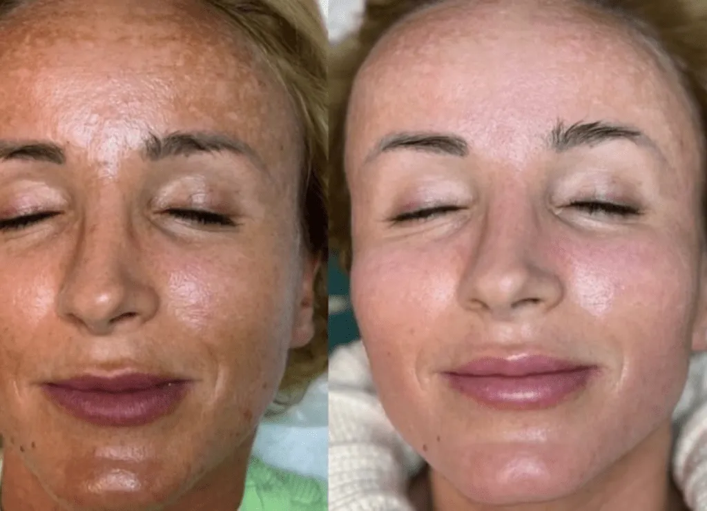 Before and after Cellstory treatment Skin Revival Specialist Marlow Bucks