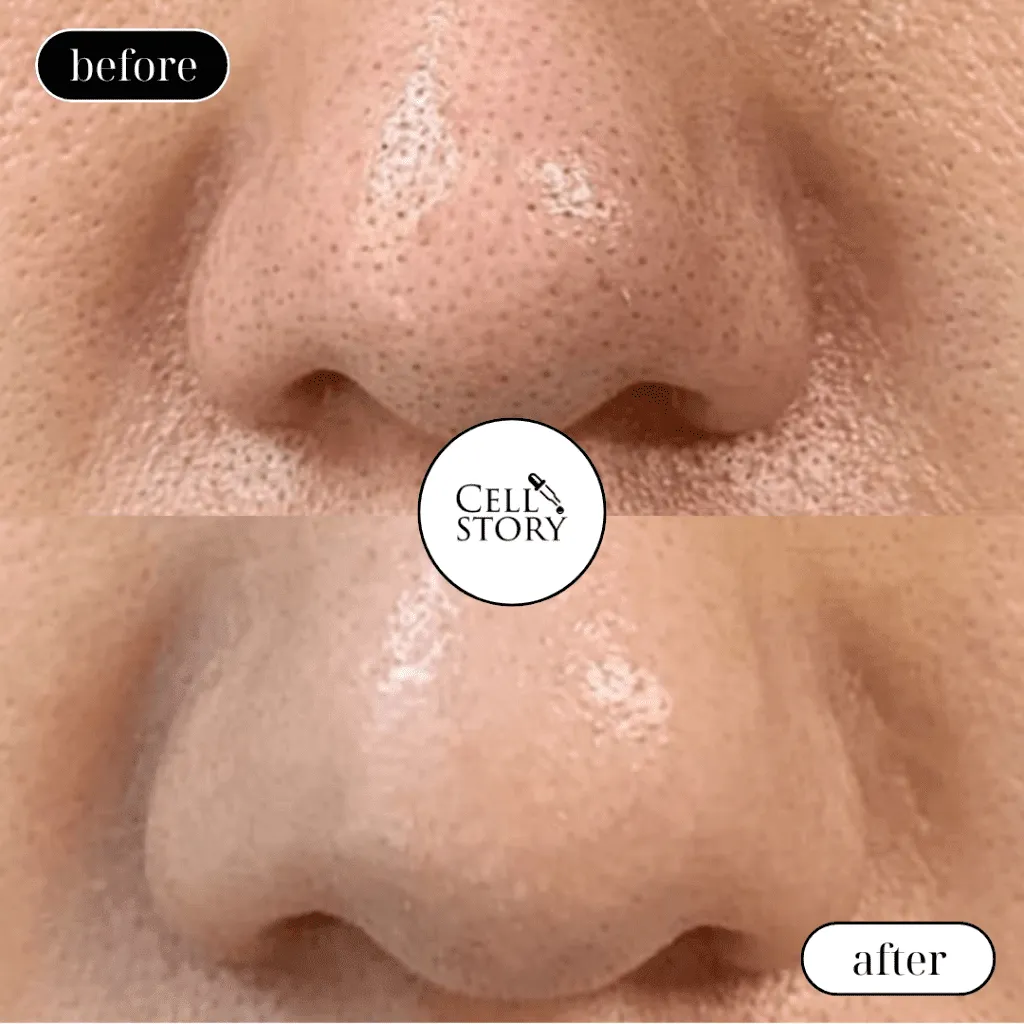 Before and after Cellstory treatment Skin Revival Specialist Marlow Bucks