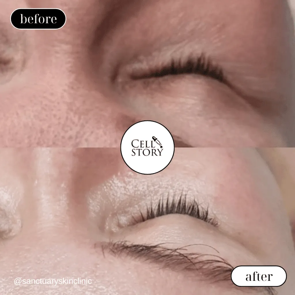 Before and after Cellstory treatment Skin Revival Specialist Marlow Bucks