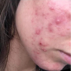 Acne client before treatment