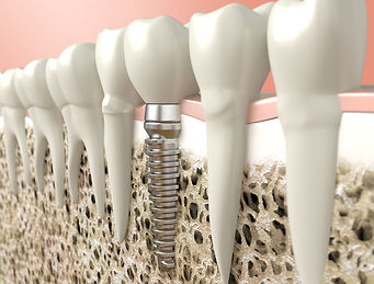 Dental Implants.jpg