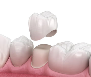 Dental Crowns.jpg