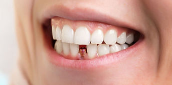 Dental Implant 02.jpg