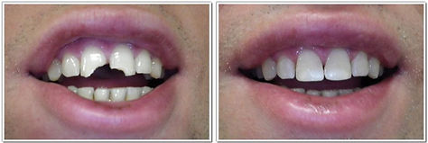 dental-bonding 01.jpg