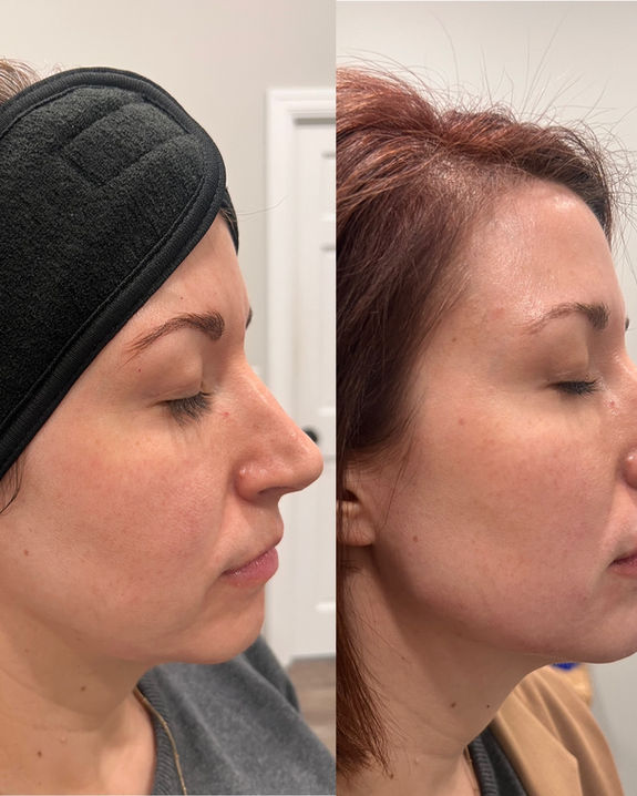 Facial balancing with filler Hutchinson KS