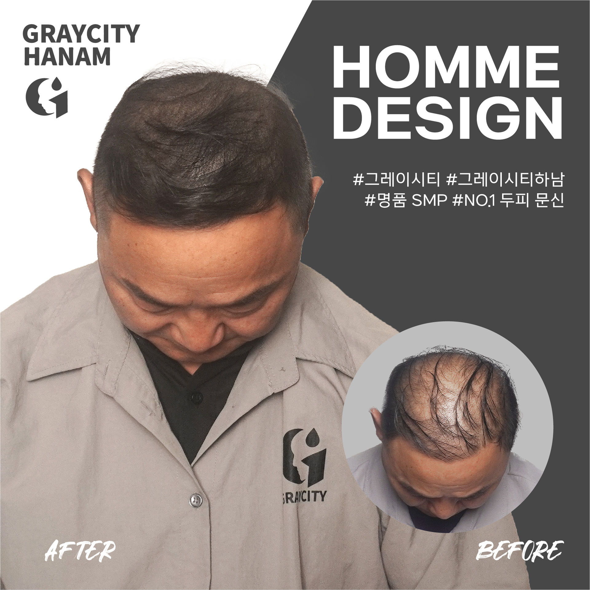 구준엽이 인정한 하남두피문신! 그레이시티 하남점! 머리카락이 자란 듯 자연스러운 탈모 커버!